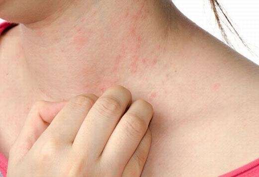 Living With Eczema How To Manage