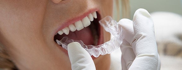 How To Locate Competent Dental Brace Providers