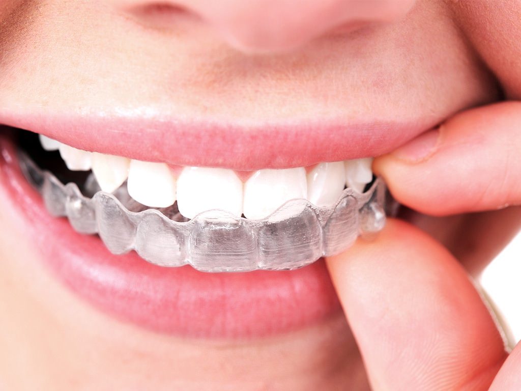5 Tips To The Best Invisalign Results